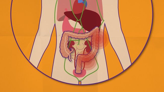 Kenali 5 Gejala Kanker Usus Besar yang Sering Diabaikan