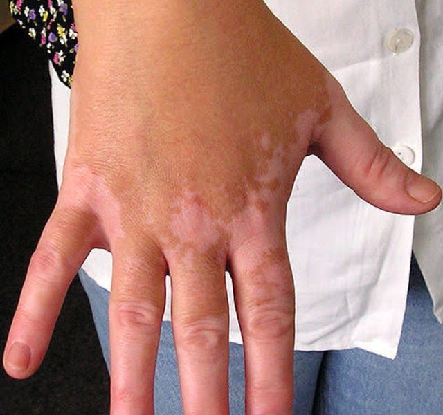 Mengenal Vitiligo, Penyakit Kulit yang Diidap Menristek Bambang